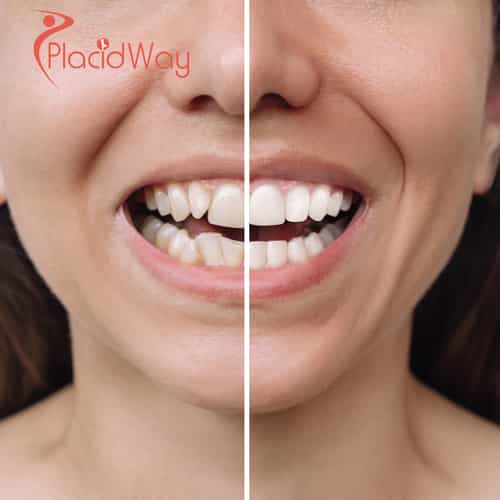 Porcelain Veneer Smile Design in Mexico for U.S. Patients